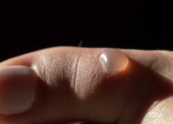 ampoules aux pieds