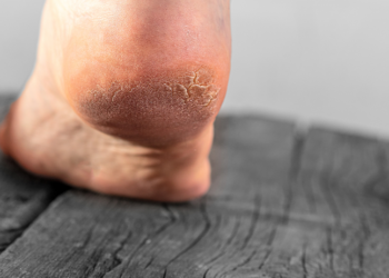 crevasses aux pieds
